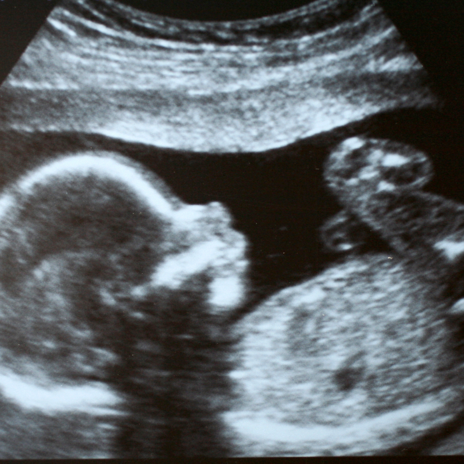 The Decision to Pursue Surrogacy